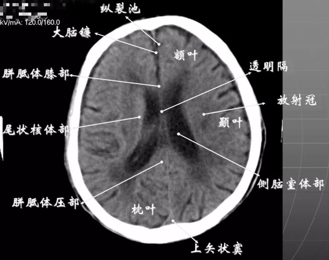 头颅CT解剖结构图片