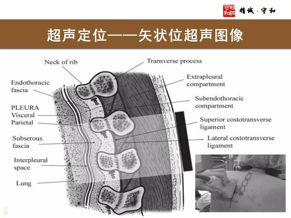 椎旁神经阻滞超声引导图片