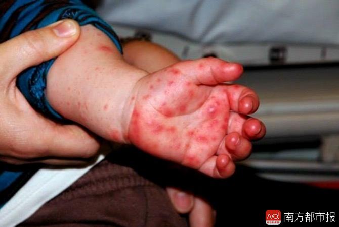 手足口病在儿童6月龄后发病率迅速升高,1岁是发病率最高的年龄段
