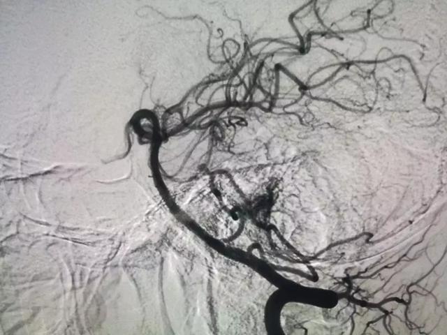 腦血管造影提示:右側小腦前下動脈血管畸形,右側小腦半球出血.