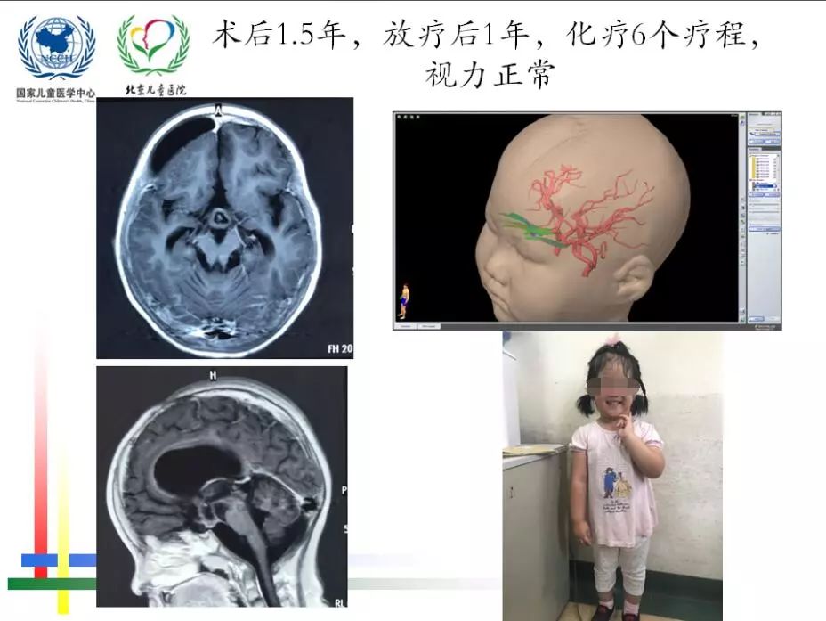 兒童視路膠質瘤手術 如何通過視覺纖維重建來保留患者視力