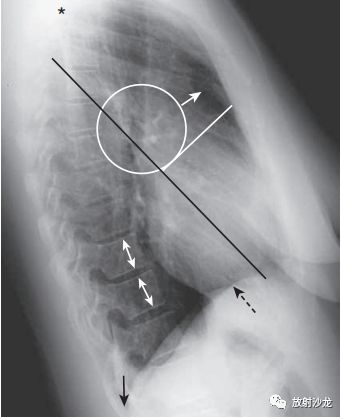 胸骨侧位图片