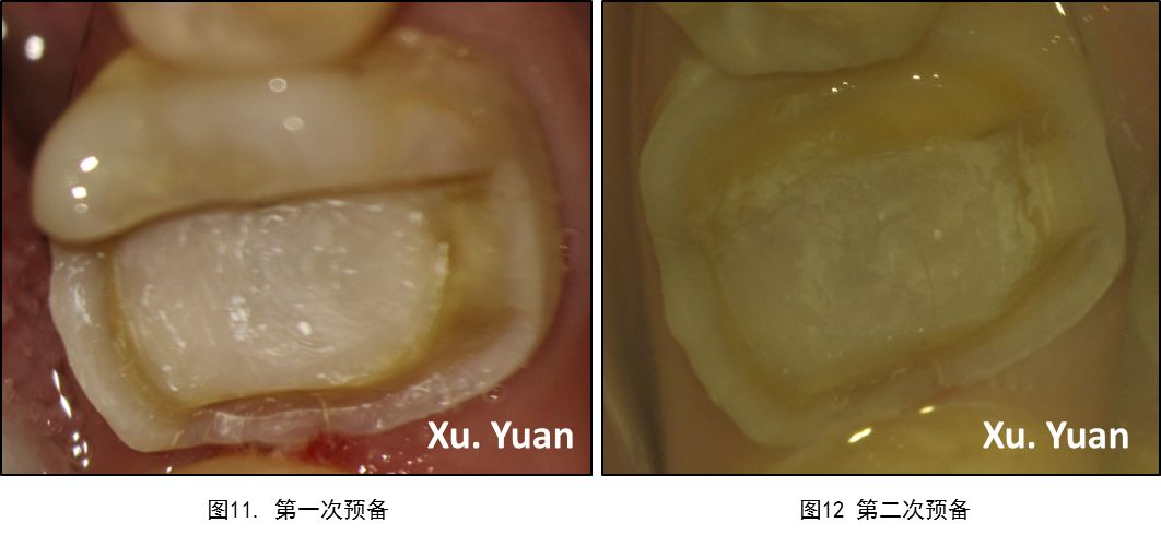 病例十五顯微根管治療與高嵌體修復右下第一磨牙慢性根尖周炎的病例