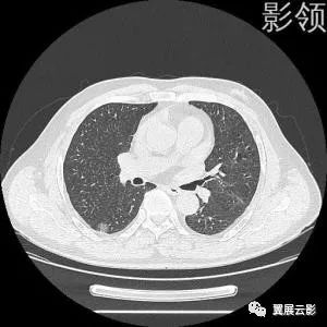 肺背段图片