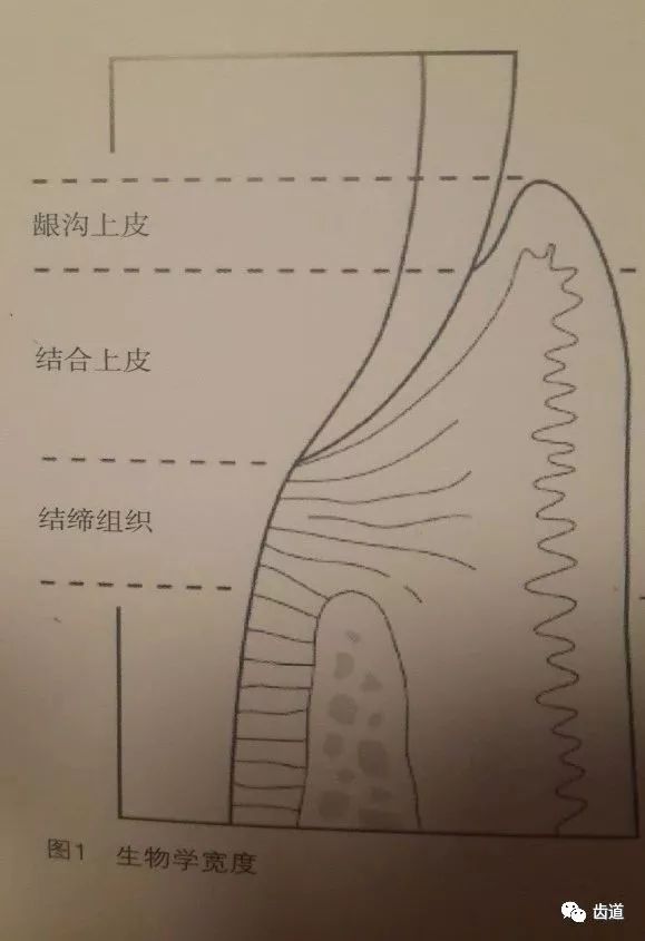 它包括结合上皮(约097mm)和牙槽嵴顶以上的结缔组织(1