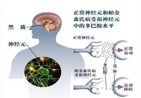 紋狀體區多巴胺遞質降低,多巴胺與乙酰膽鹼遞質失平衡而發