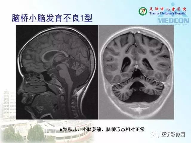 先天性小脑畸形的影像学表现