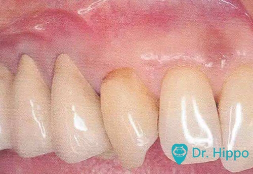 牙周袋看上去颜色牙周袋殷红,水肿,质地松软变厚,龈缘圆钝,与牙面分离
