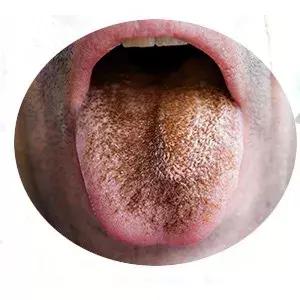 舌头灰褐色图片
