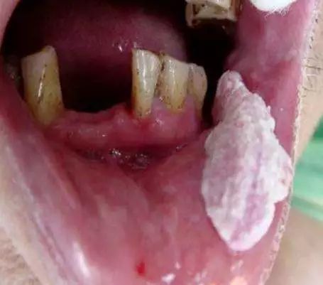 据统计,90%以上的口腔癌 都与槟榔相关 口腔癌的前身 就是口腔黏膜