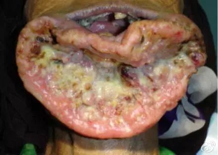 长期吃槟榔的口腔照片图片