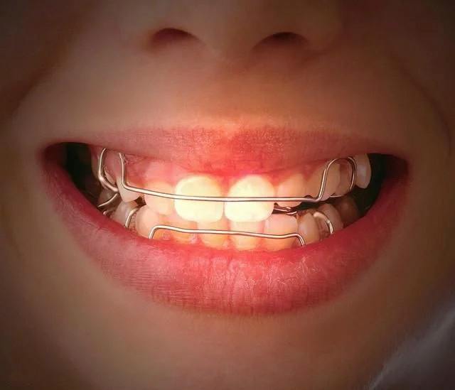 儿童牙齿支架图片图片
