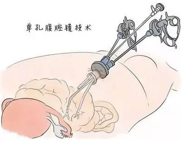 【新闻快递】医院妇科成功完成单孔腹腔镜下异位妊娠手术