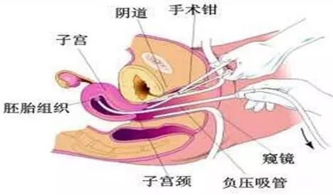 人工流产刮宫术图片