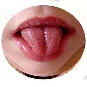 正常的舌头是淡红色的,如果出现明亮的红舌头,像草莓一样,则可能预示