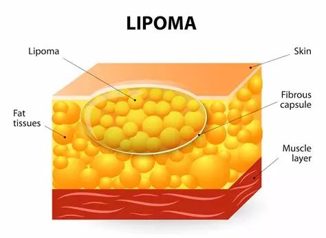 皮下長了脂肪瘤怎麼辦