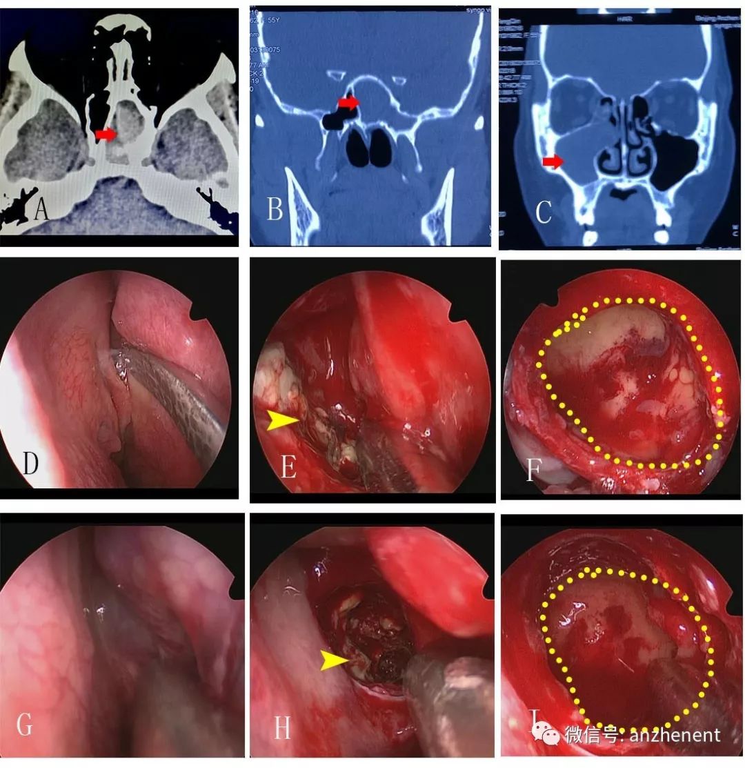 全组鼻窦炎图片