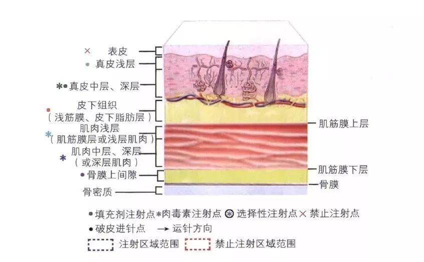 肉毒素注射方法图片