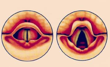 声 带病变最常见的类型有声带小结,声带息肉,任克水肿等病变,声带小结