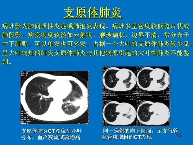 肺部炎症的影像学汇总