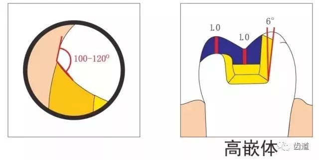 二,全瓷牙备牙要求连冠或桥冠体制备时,共同就位道的取得和倒凹的消除