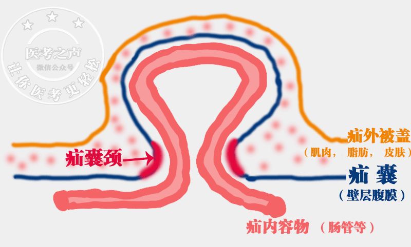 疝进去的 洞口 疝囊颈 疝环所在部位)