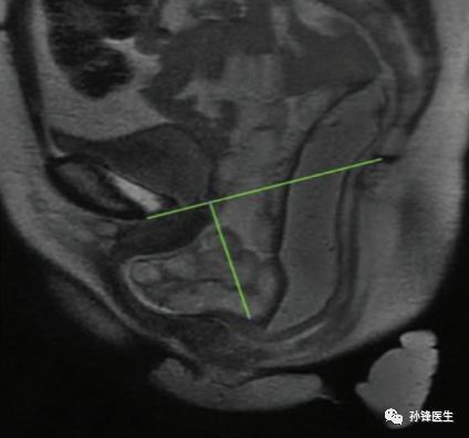 醫學潮頭ascrs肛門直腸生理檢測及盆底專業術語和定義