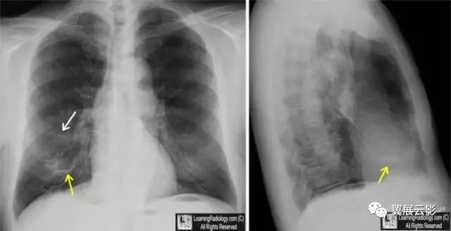 囊状支气管扩张的影像表现