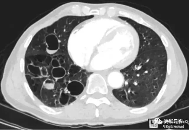 囊状支气管扩张的影像表现