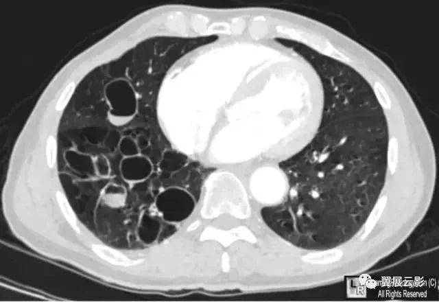 支气管囊肿影像图片