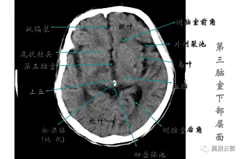 头颅ct扫描基线图解图片