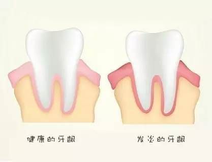 健康的牙龈一般呈粉红色,牙齿和牙床是紧紧连在一起的,没有缝隙,当