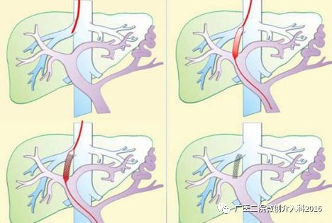 门体分流手术图解图片