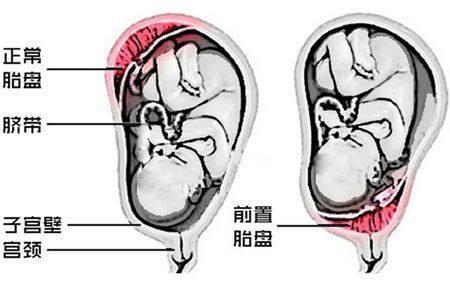 胎盘前壁和胎盘后壁有什么区别解析二者的作用与不同