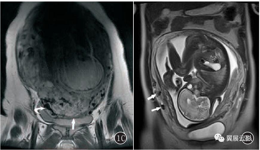 核磁共振胎盘植入图片图片