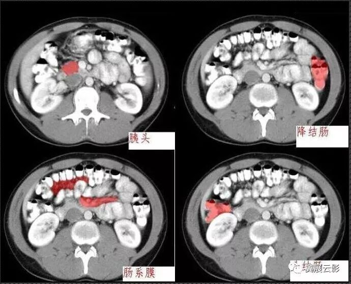 10分钟学会腹盆部ct解剖