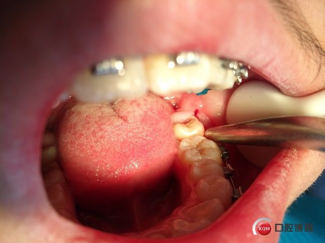 Ⅲ类低位近中颊侧水平埋伏阻生拔除术