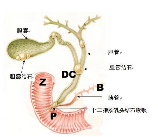 為什麼膽囊容易長結石(粵語)