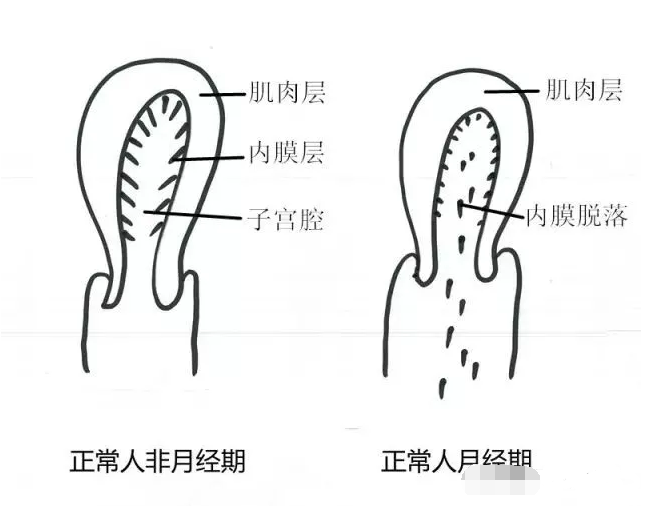 图左侧是正常人没有来月经时期的子宫示意图,子宫有肌肉层,内膜层