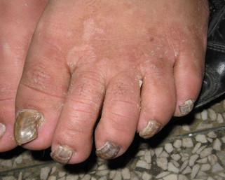 脚上的灰指甲是怎么引起的?