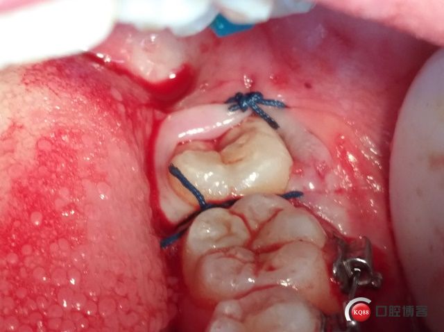 Ⅲ类低位近中颊侧水平埋伏阻生拔除术