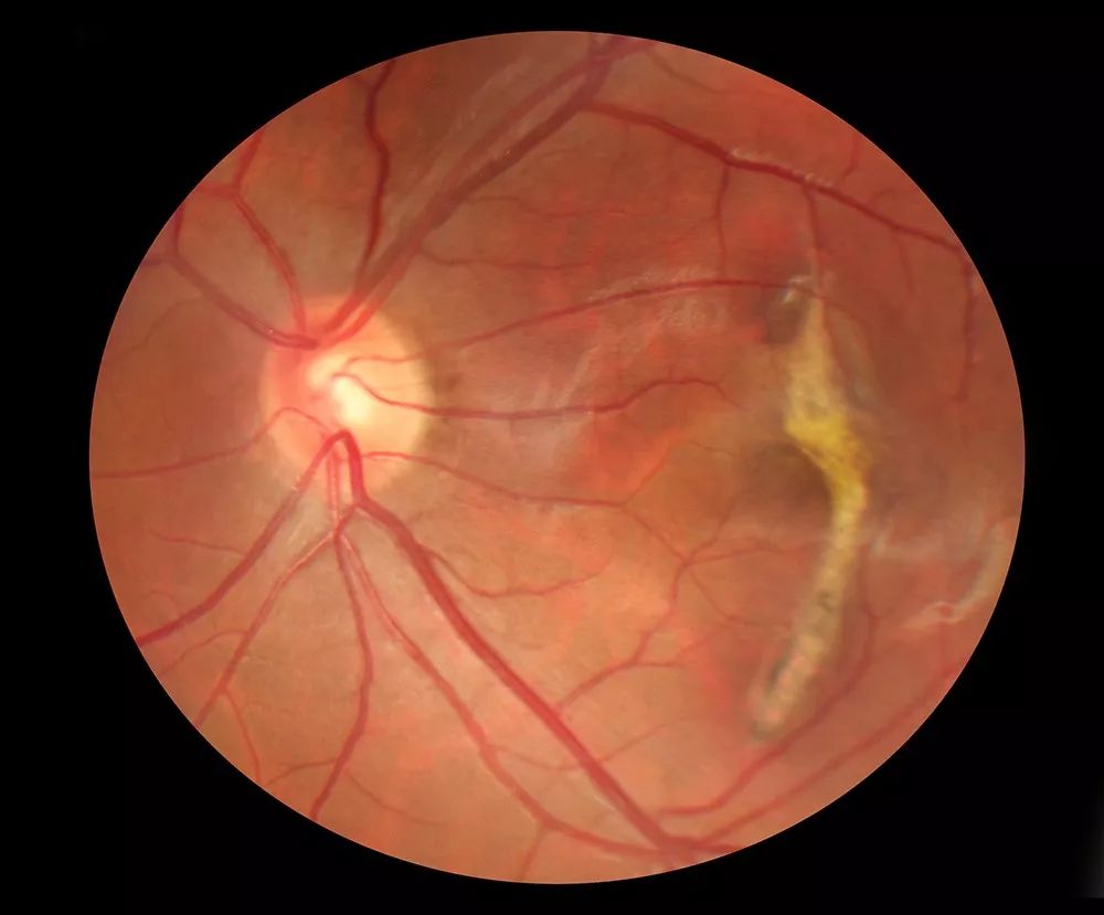 视网膜病变的症状图片图片
