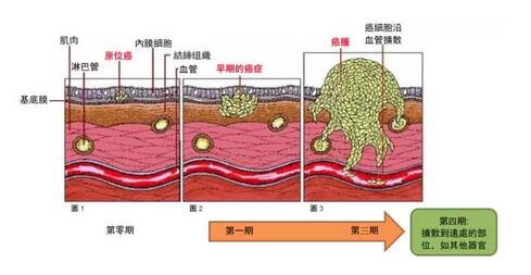 癌症癌細胞的擴散和轉移有什麼不同