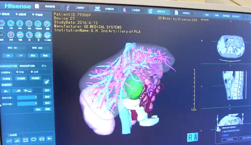 三维影像成外科医生"神器,海信cas助力根治高原"虫癌"