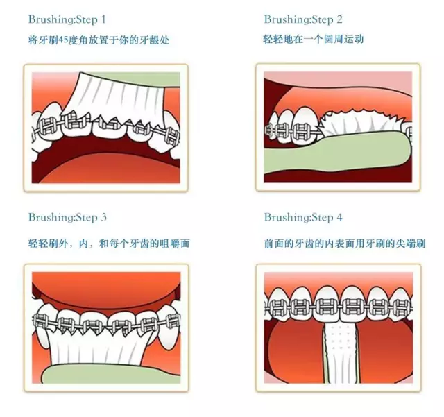 正畸过程中护理常识