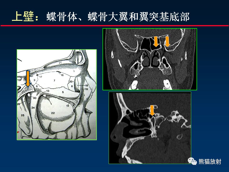 顱底重要ct解剖及其臨床意義