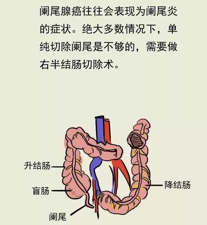 慢性阑尾炎症状图片