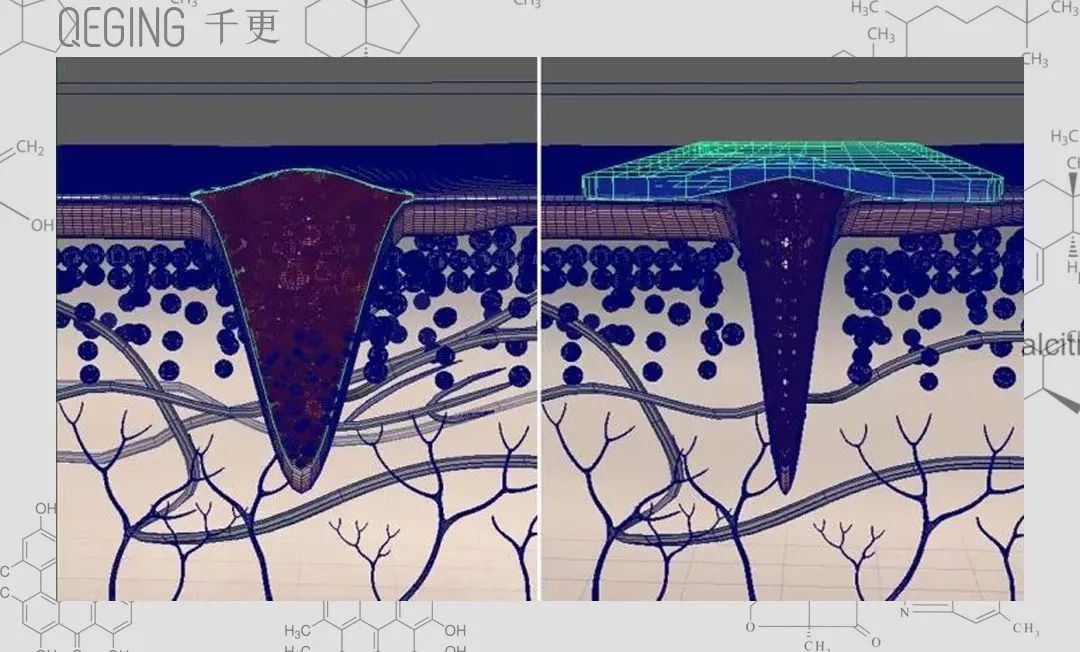 而 七玥老師的方法是採用2微米離子態直接打入真皮層把深層