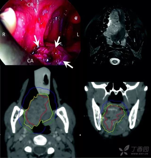 喉,下咽,口咽和口腔原发肿瘤临床靶区 (ctv