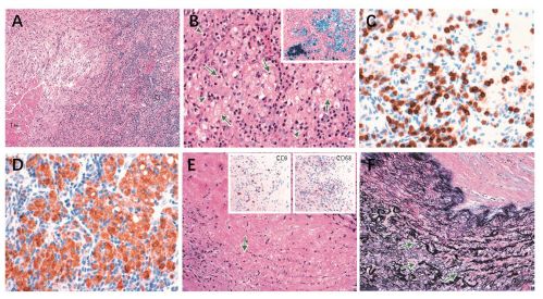 nejm複發性靜脈血栓栓塞和肺動脈瘤的病因是